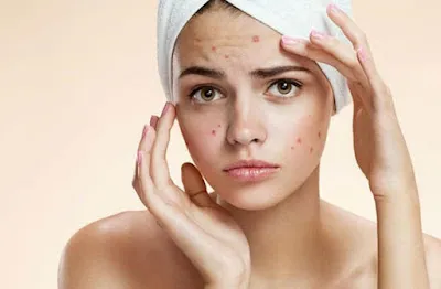 Dark Spots Removal
